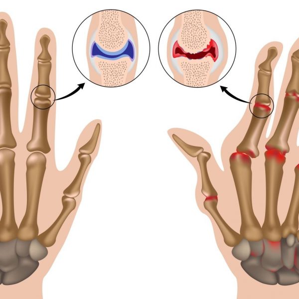 Ревматоидный полиатрит